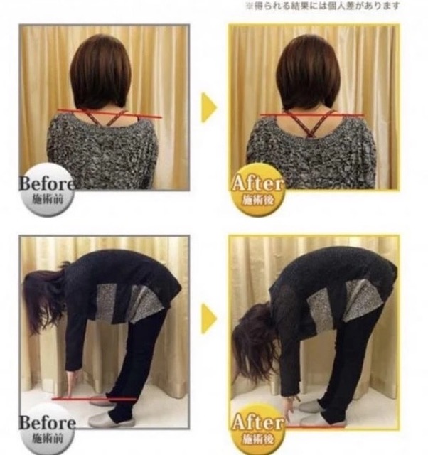 施術後のBeforeAfter画像