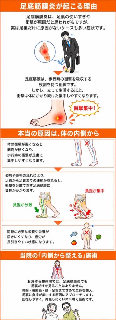 足底筋膜炎が起こる理由