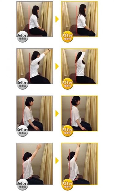 猫背施術後のBefore/After画像